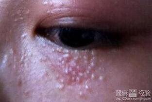 脂肪粒去除视频,跟随视频教程一招搞定